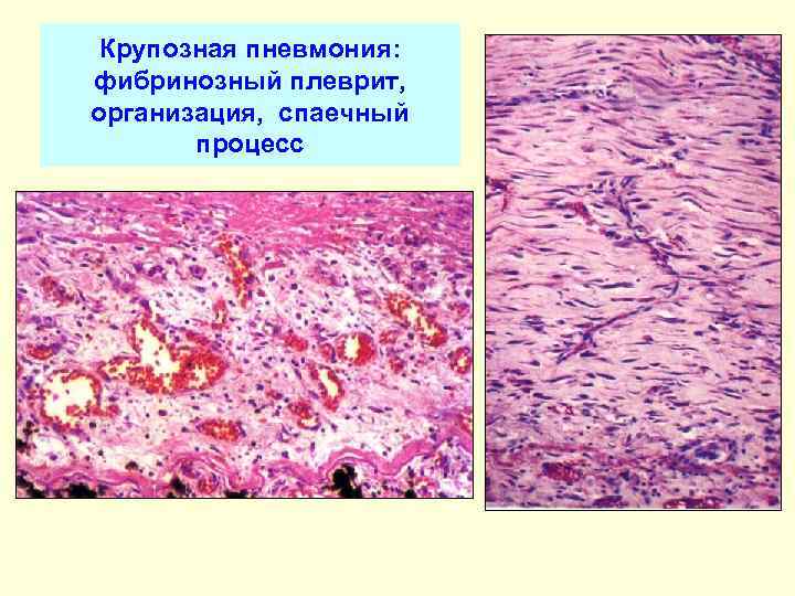 Крупозная пневмония: фибринозный плеврит, организация, спаечный процесс 