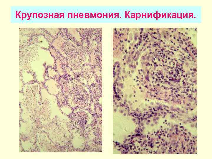 Крупозная пневмония. Карнификация. 