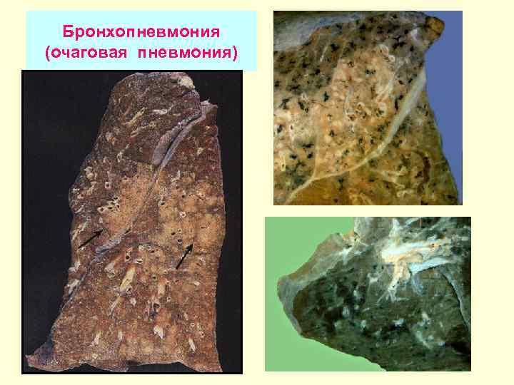 Бронхопневмония (очаговая пневмония) 