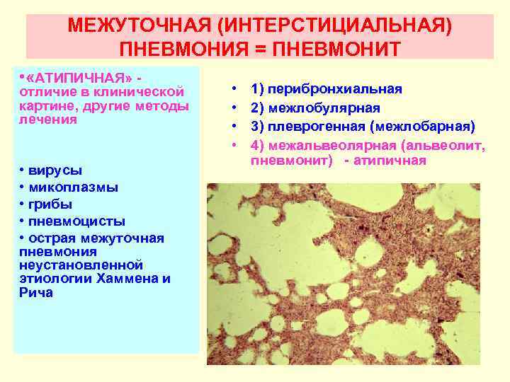 МЕЖУТОЧНАЯ (ИНТЕРСТИЦИАЛЬНАЯ) ПНЕВМОНИЯ = ПНЕВМОНИТ • «АТИПИЧНАЯ» - отличие в клинической картине, другие методы