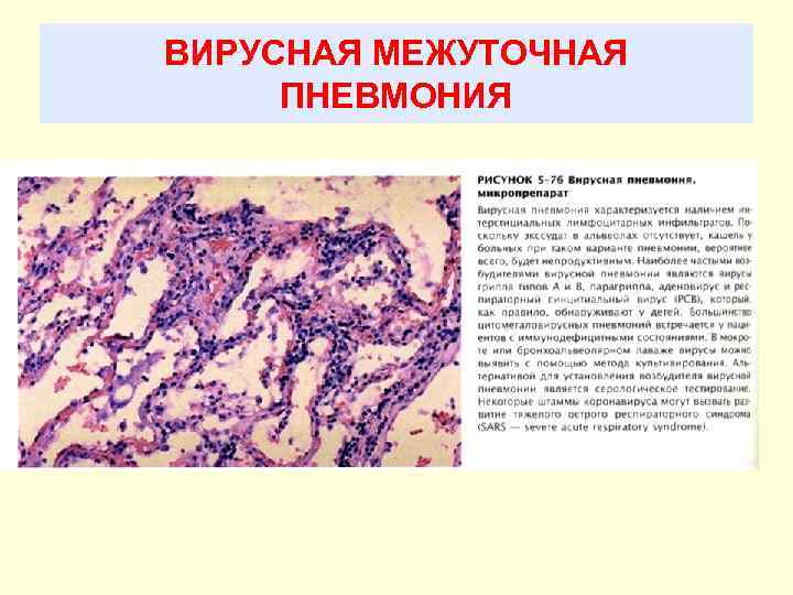 ВИРУСНАЯ МЕЖУТОЧНАЯ ПНЕВМОНИЯ 