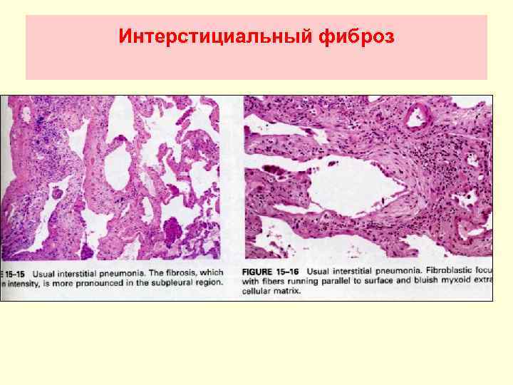 Болезни органов дыхания презентация патанатомия