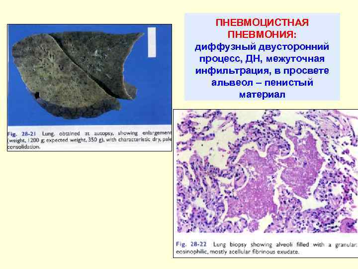 ПНЕВМОЦИСТНАЯ ПНЕВМОНИЯ: диффузный двусторонний процесс, ДН, межуточная инфильтрация, в просвете альвеол – пенистый материал