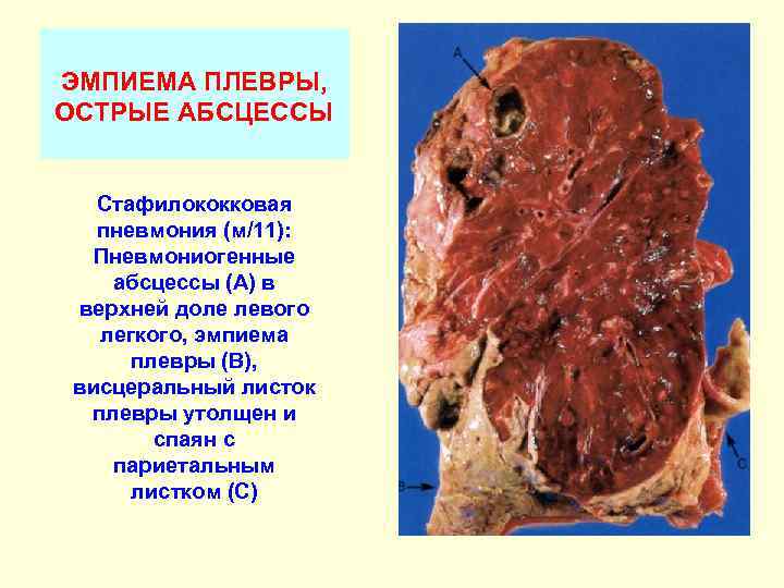 ЭМПИЕМА ПЛЕВРЫ, ОСТРЫЕ АБСЦЕССЫ Стафилококковая пневмония (м/11): Пневмониогенные абсцессы (А) в верхней доле левого