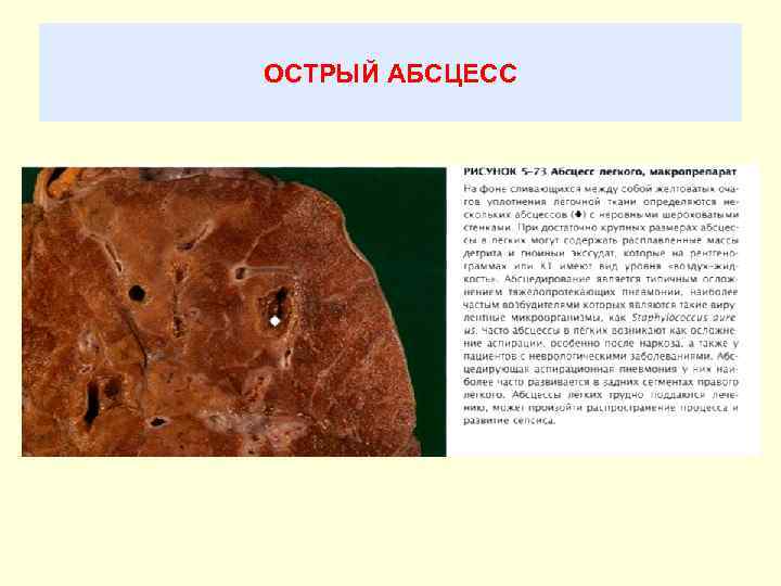 ОСТРЫЙ АБСЦЕСС 