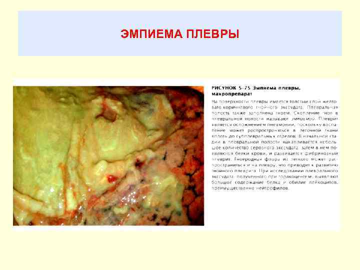 ЭМПИЕМА ПЛЕВРЫ 