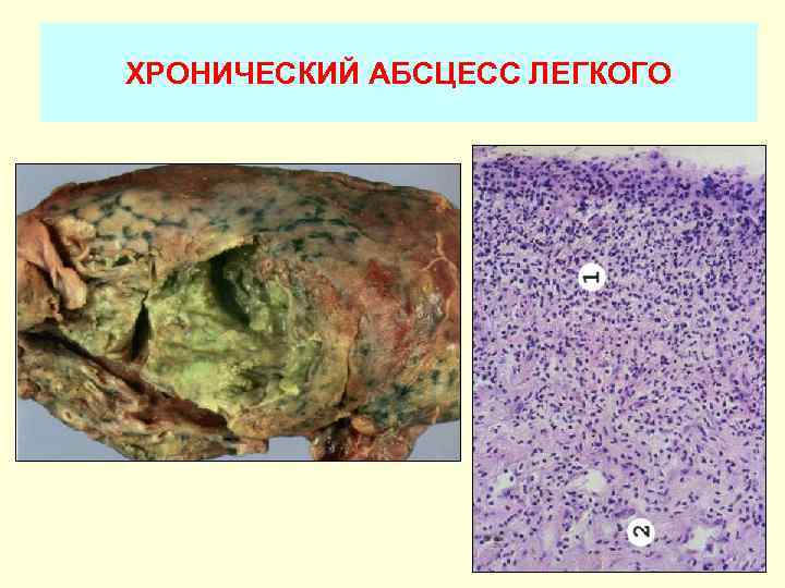 Презентация на тему абсцесс легких