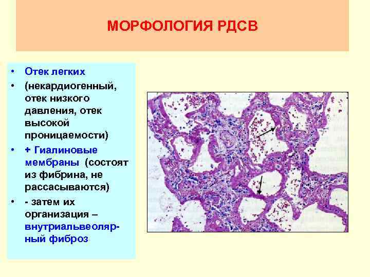 Болезни органов дыхания патанатомия презентация