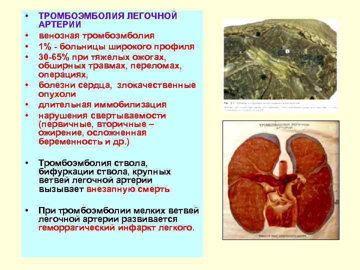  • • ТРОМБОЭМБОЛИЯ ЛЕГОЧНОЙ АРТЕРИИ венозная тромбоэмболия 1% - больницы широкого профиля 30