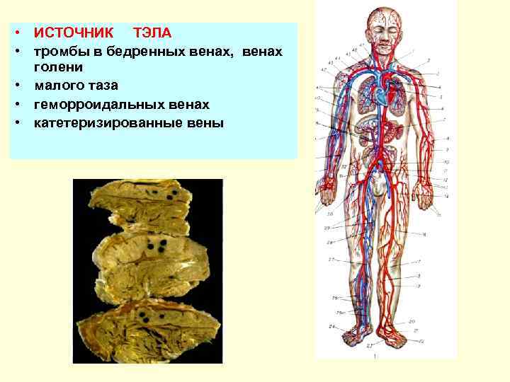  • ИСТОЧНИК ТЭЛА • тромбы в бедренных венах, венах голени • малого таза