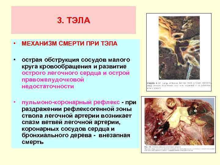 3. ТЭЛА • МЕХАНИЗМ СМЕРТИ ПРИ ТЭЛА • острая обструкция сосудов малого круга кровообращения
