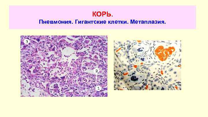 КОРЬ. Пневмония. Гигантские клетки. Метаплазия. 