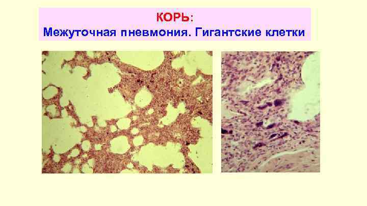 КОРЬ: Межуточная пневмония. Гигантские клетки 
