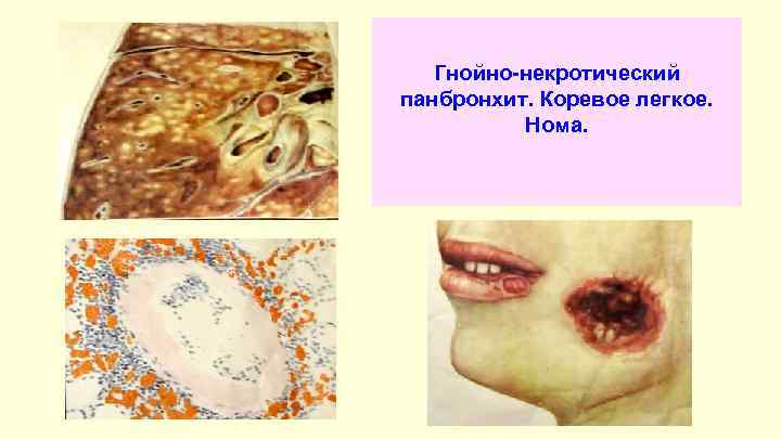 Гнойно-некротический панбронхит. Коревое легкое. Нома. 