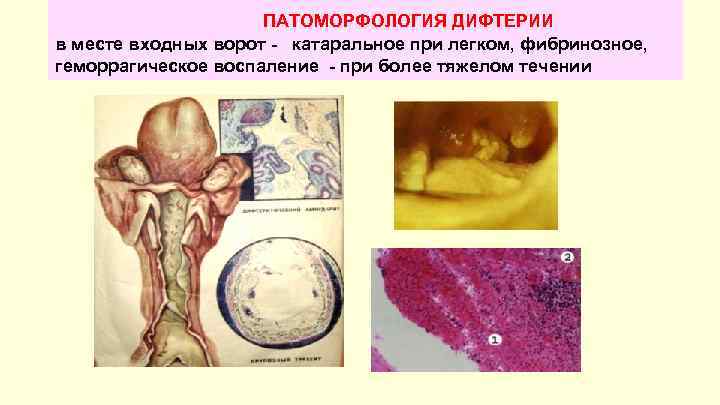 Флебодиа при геморрое схема