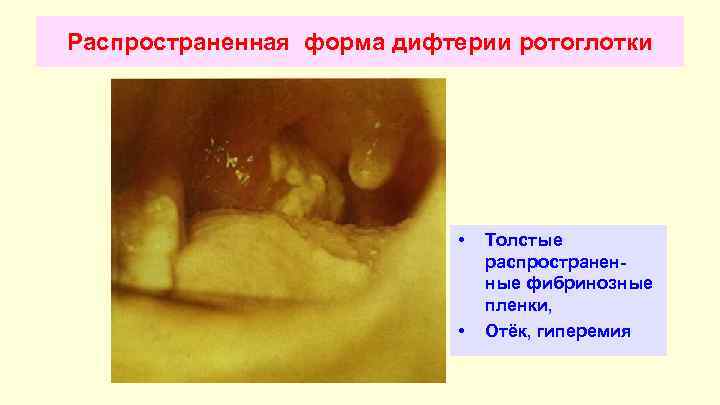 Дифтерия ротоглотки у детей фото