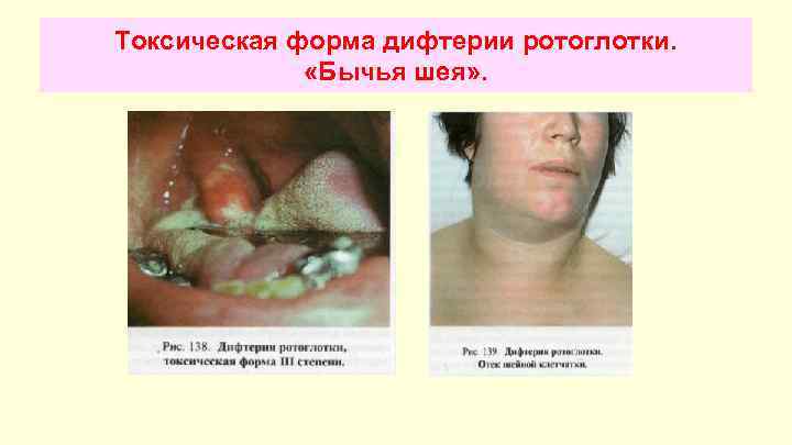 Токсическая форма дифтерии ротоглотки. «Бычья шея» . 
