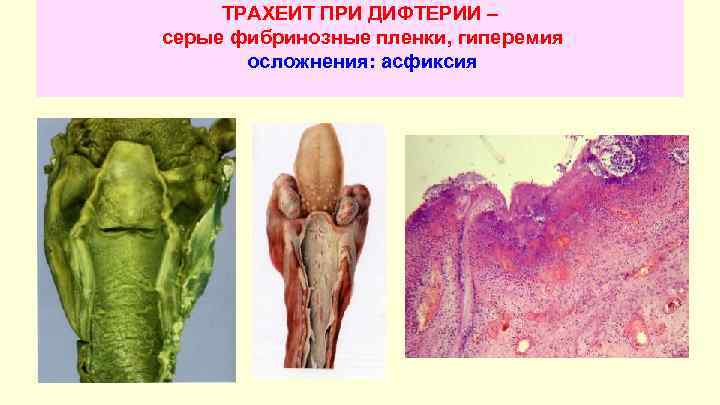 ТРАХЕИТ ПРИ ДИФТЕРИИ – серые фибринозные пленки, гиперемия осложнения: асфиксия 