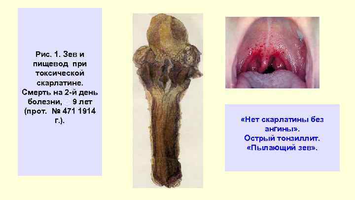 Рис. 1. Зев и пищевод при токсической скарлатине. Смерть на 2 -й день болезни,