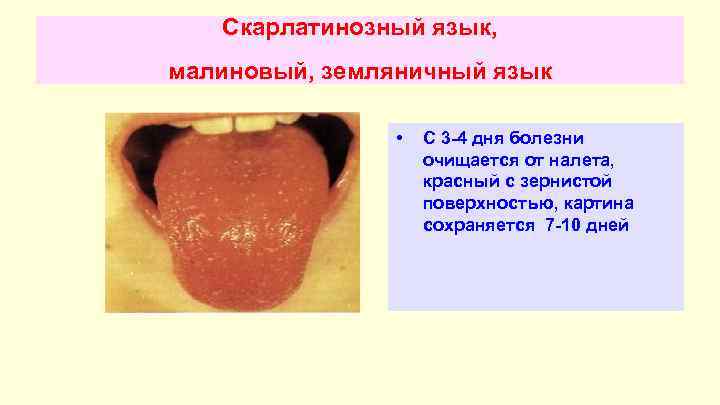 Скарлатинозный язык, малиновый, земляничный язык • С 3 -4 дня болезни очищается от налета,
