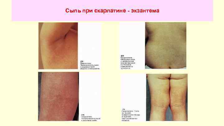 Сыпь при скарлатине - экзантема 