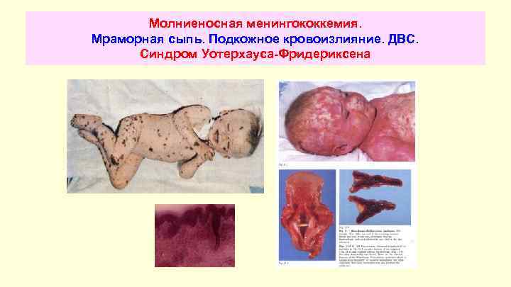 Молниеносная менингококкемия. Мраморная сыпь. Подкожное кровоизлияние. ДВС. Синдром Уотерхауса-Фридериксена 