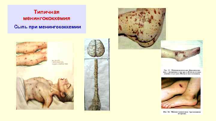 Типичная менингококкемия Сыпь при менингококкемии 