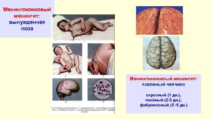 Менингококковый менингит: вынужденная поза Менингококковый менингит: «зеленый чепчик» серозный (1 дн. ), гнойный (2