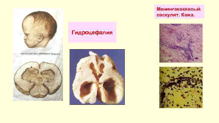 Менингококковый васкулит. Кожа. Гидроцефалия 