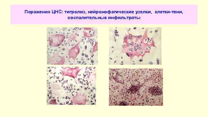 Поражения ЦНС: тигролиз, нейронофагические узелки, клетки-тени, воспалительные инфильтраты 