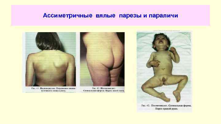 Ассиметричные вялые парезы и параличи 