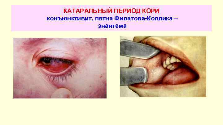 КАТАРАЛЬНЫЙ ПЕРИОД КОРИ конъюнктивит, пятна Филатова-Коплика – энантема 