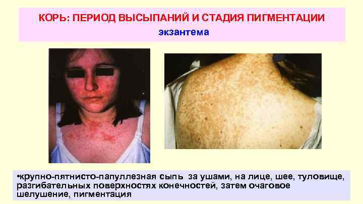 КОРЬ: ПЕРИОД ВЫСЫПАНИЙ И СТАДИЯ ПИГМЕНТАЦИИ экзантема • крупно-пятнисто-папуллезная сыпь за ушами, на лице,