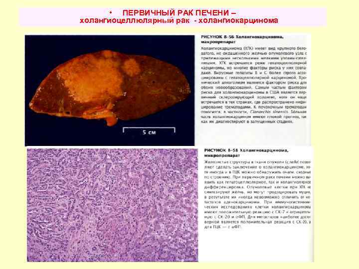  • ПЕРВИЧНЫЙ РАК ПЕЧЕНИ – холангиоцеллюлярный рак - холангиокарцинома 