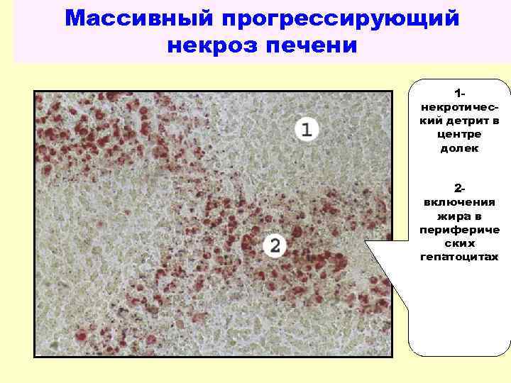 Массивный прогрессирующий некроз печени 1 некротический детрит в центре долек 2 включения жира в