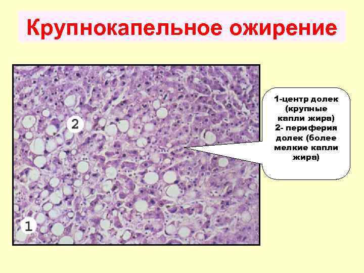 Ожирение 1 степени фото