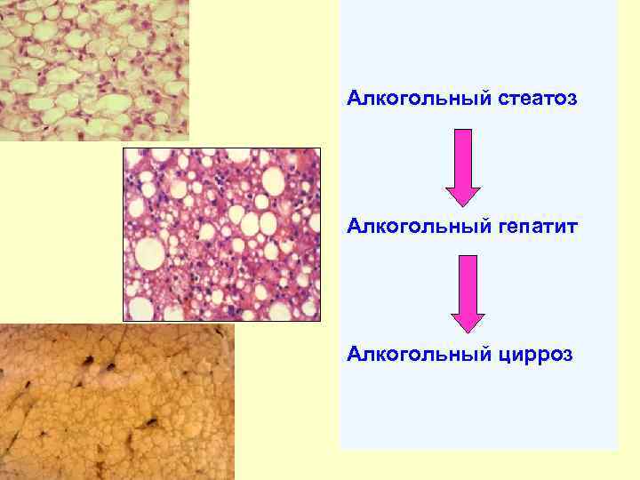 Алкогольный гепатит