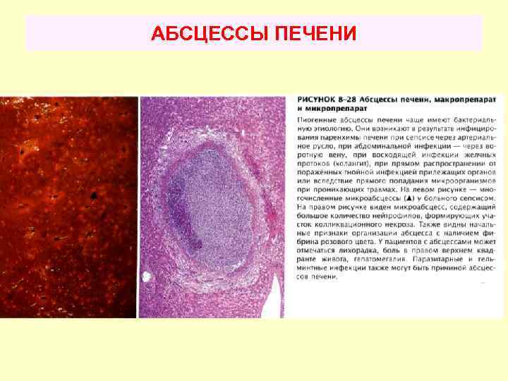 АБСЦЕССЫ ПЕЧЕНИ 