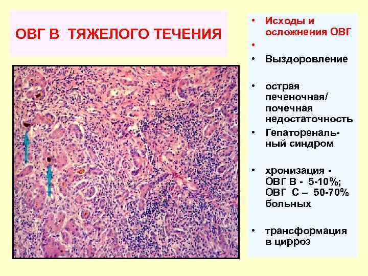 ОВГ B ТЯЖЕЛОГО ТЕЧЕНИЯ • Исходы и осложнения ОВГ • • Выздоровление • острая