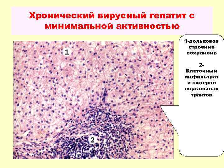 Хронический гепатит умеренной активности