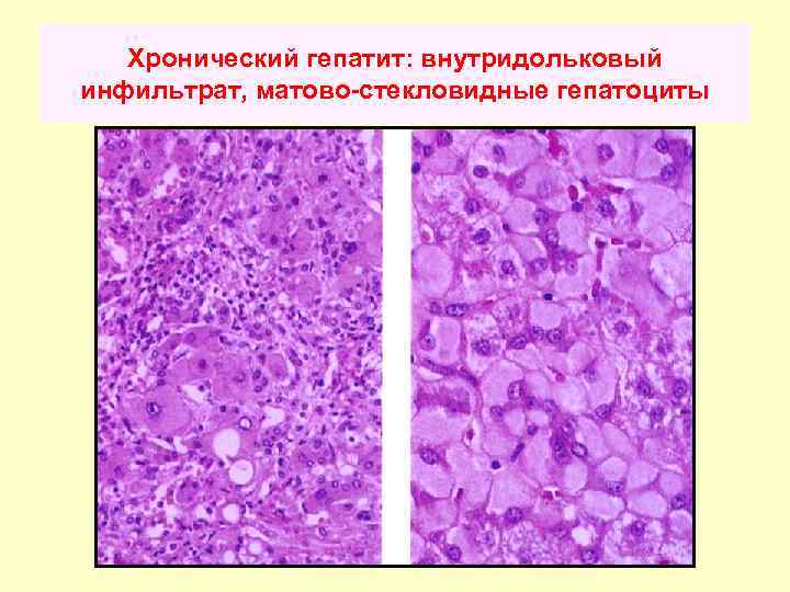 Хронический гепатит: внутридольковый инфильтрат, матово-стекловидные гепатоциты 