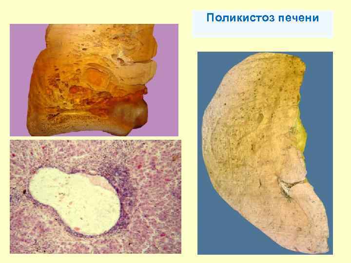 Поликистоз печени 