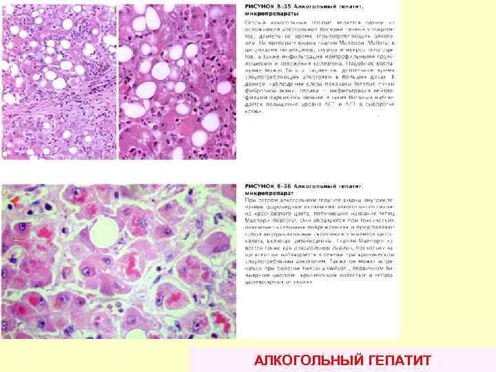 АЛКОГОЛЬНЫЙ ГЕПАТИТ 