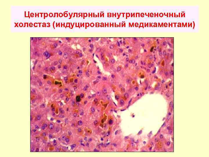 Хронический холестаз. Центролобулярные некрозы печени. Внутрипеченочный холестаз гистология. Центролобулярный некроз гепатоцитов. Центролобулярные некрозы гепатоцитов желтуха.
