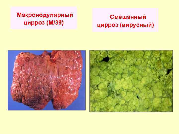 Макронодулярный цирроз (М/39) Смешанный цирроз (вирусный) 