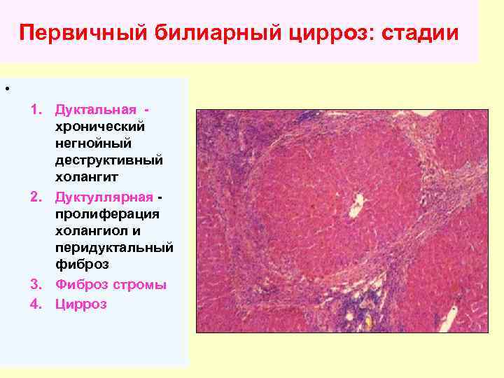 Первичный билиарный цирроз: стадии • 1. Дуктальная хронический негнойный деструктивный холангит 2. Дуктуллярная пролиферация