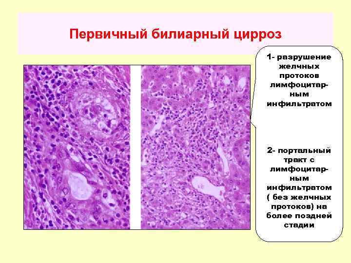 Первичный билиарный цирроз 1 - разрушение желчных протоков лимфоцитарным инфильтратом 2 - портальный тракт