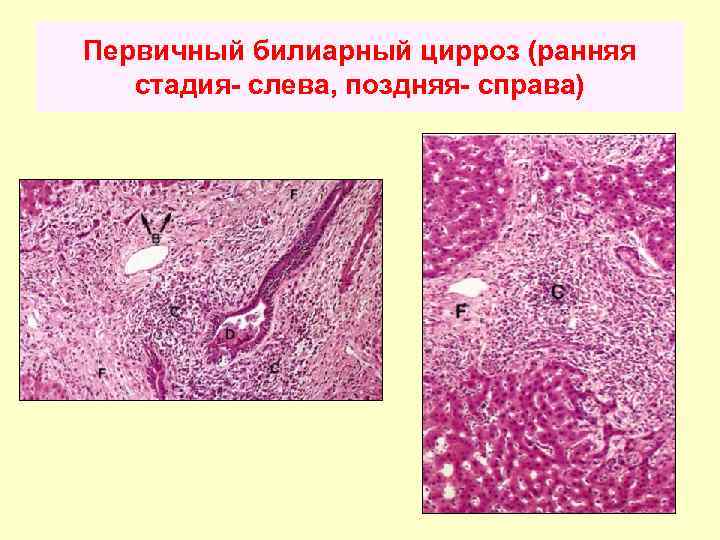 Первичный билиарный цирроз (ранняя стадия- слева, поздняя- справа) 