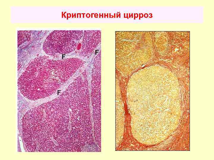 При классической картине цирроза в ультразвуковой картине печени