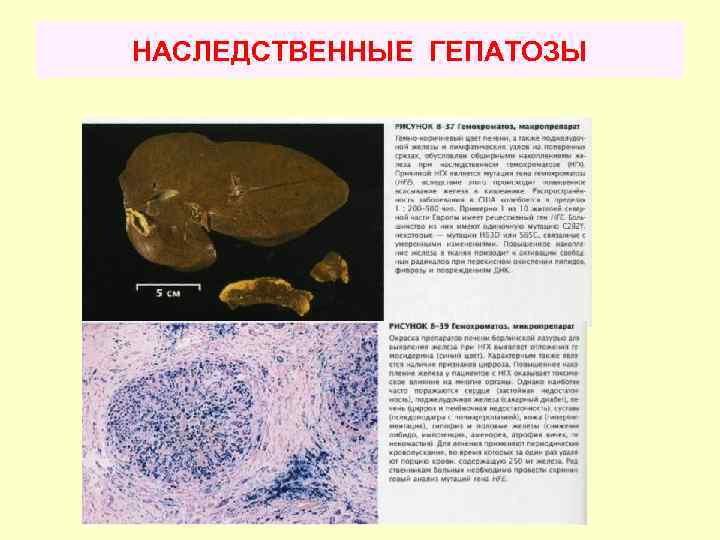 НАСЛЕДСТВЕННЫЕ ГЕПАТОЗЫ 